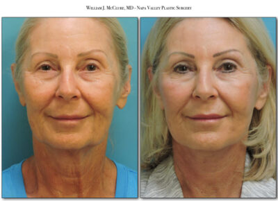 Facelift – Dr. McClure 5