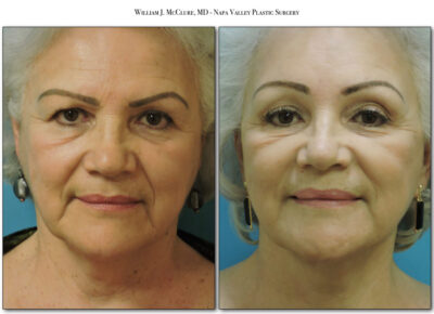 Facelift – Dr. McClure 11