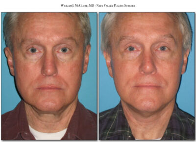 Facelift – Dr. McClure 46