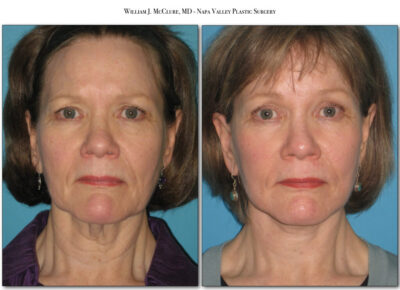 Browlift – Dr. McClure 11