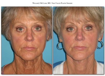 Facelift – Dr. McClure 4