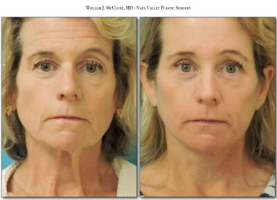 Browlift – Dr. McClure 2