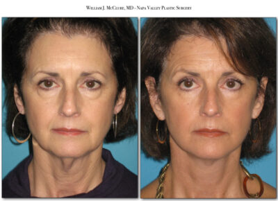 Facelift – Dr. McClure 20