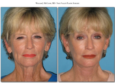 Browlift – Dr. McClure 16
