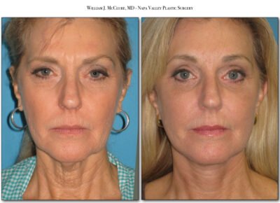 Facelift – Dr. McClure 22