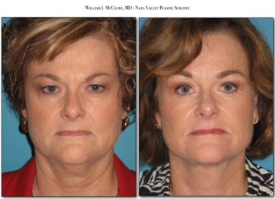 Browlift – Dr. McClure 10