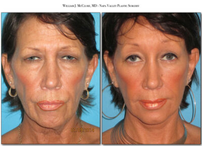 Browlift – Dr. McClure 14
