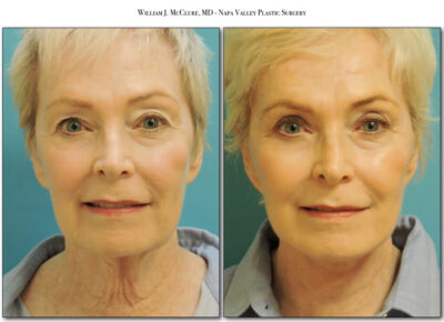 Facelift – Dr. McClure 1