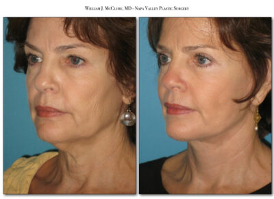 Facelift – Dr. McClure 6
