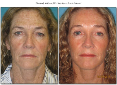 Browlift – Dr. McClure 18