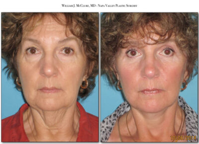Facelift – Dr. McClure 28