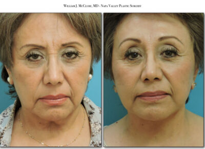 Facelift – Dr. McClure 29