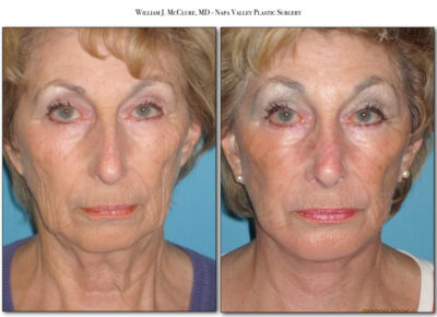 Facelift – Dr. McClure 32