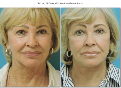 Facelift – Dr. McClure 34