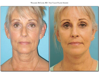 Facelift – Dr. McClure 2