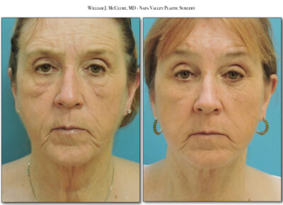 Facelift – Dr. McClure 37