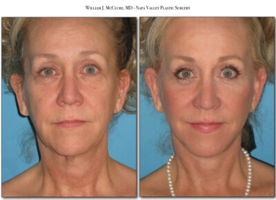 Facelift – Dr. McClure 39