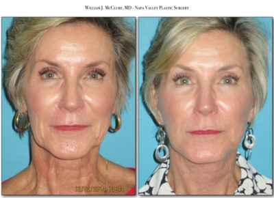 Facelift – Dr. McClure 40