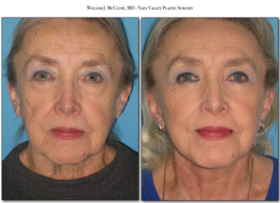 Facelift – Dr. McClure 41