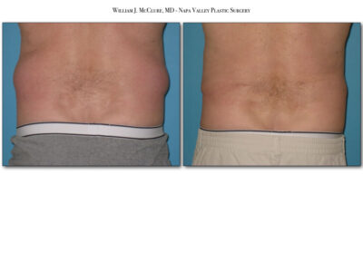 Liposuction – Dr. McClure 2