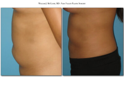 Liposuction – Dr. McClure 3
