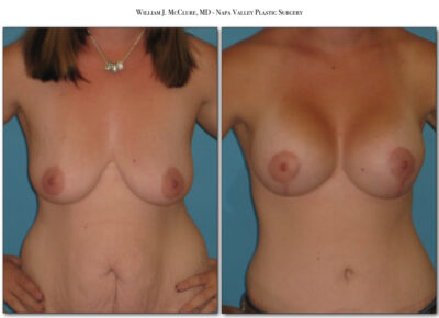 Mommy Makeover – Dr. McClure 7