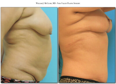 Mommy Makeover – Dr. McClure 1