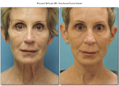 Facelift – Dr. McClure 8