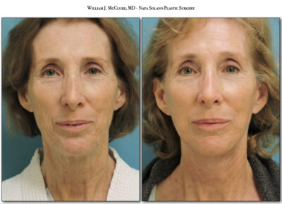 Facelift – Dr. McClure 12