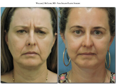 Browlift – Dr. McClure 8