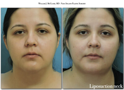 Liposuction – Dr. McClure 4