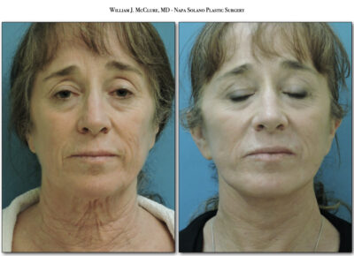Facelift – Dr. McClure 13