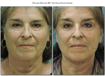 Facelift – Dr. McClure 18