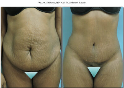 Abdominoplasty – Dr. McClure 1