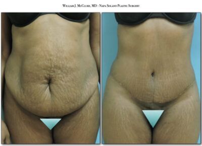 Abdominoplasty – Dr. McClure 1