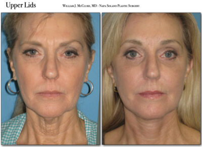 Browlift – Dr. McClure 4