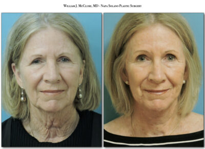 Browlift – Dr. McClure 5
