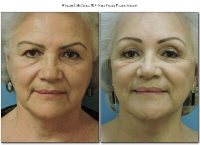 Browlift – Dr. McClure 7