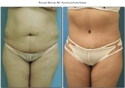 Abdominoplasty – Dr. McClure 4
