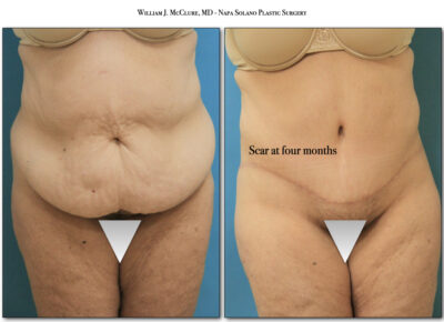 Abdominoplasty – Dr. McClure 5