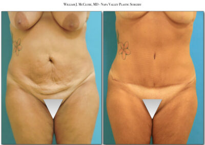 Abdominoplasty – Dr. McClure 3