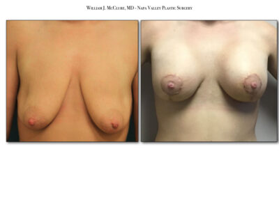 Breast Lift with Implants – Dr. McClure 5