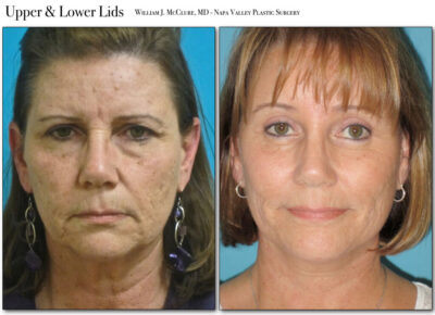Browlift – Dr. McClure 3