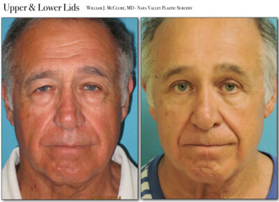 Browlift – Dr. McClure 34