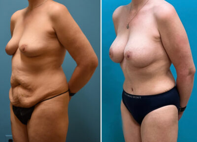 Mommy Makeover – Dr. Zeiderman 2