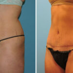 Thumbnail of http://tummy%20tuck%20patient