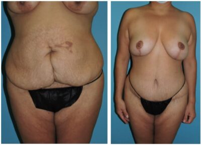 Abdominoplasty – Dr. Snyder Patient 11