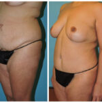 Thumbnail of http://Abdominoplasty%20Before%20and%20After