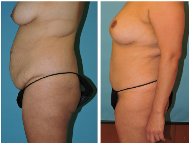 Abdominoplasty Before and After