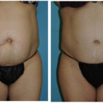 Thumbnail of http://Abdominoplasty%20Before%20&%20After